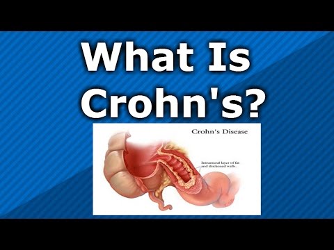 What is Crohn's Disease?????